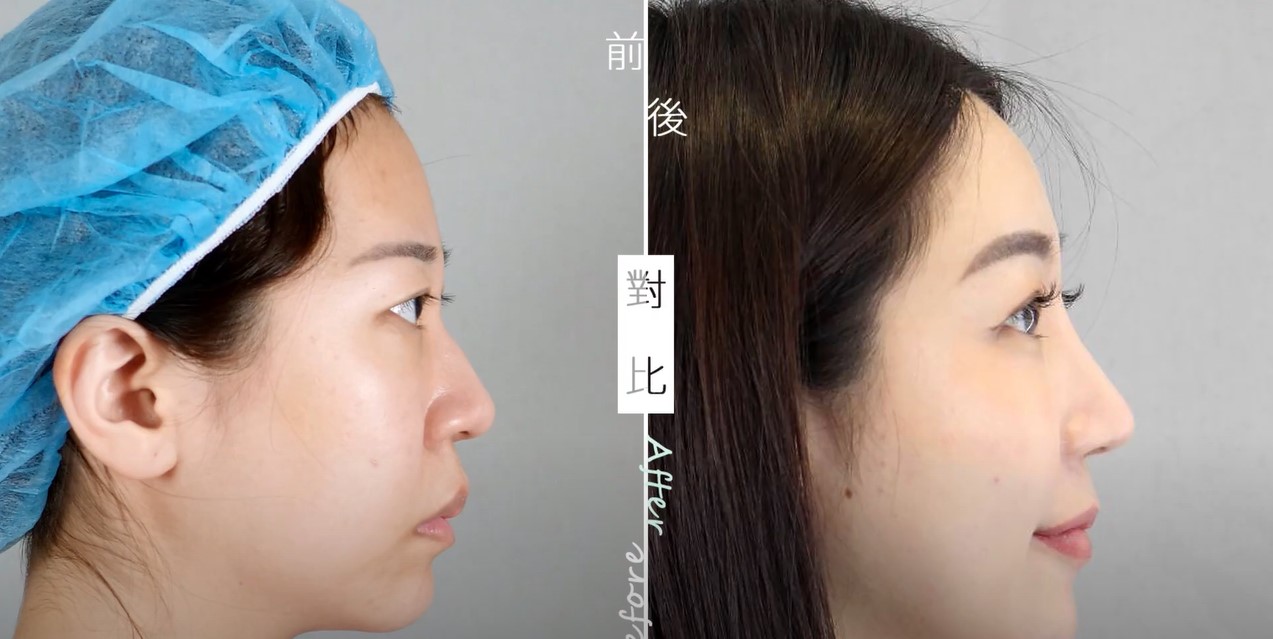 【雙眼皮+前額拉皮手術+半自肋結構式鼻整形】
